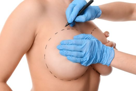 mamoplastia-1